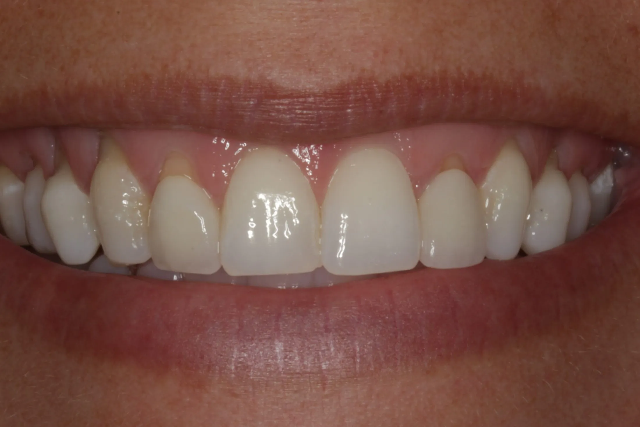 Initial condition of gums before undergoing gum grafting treatment at Westport Periodontics.
