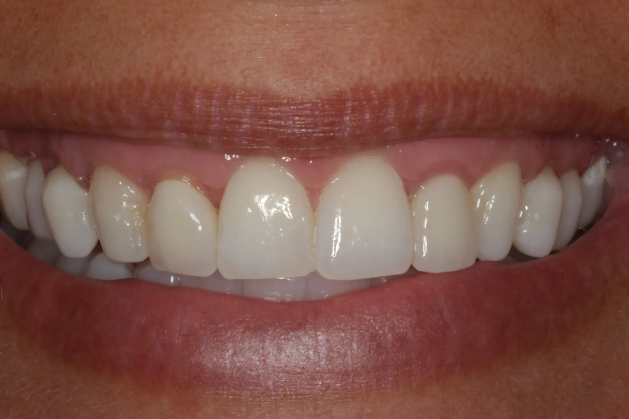 Healed gums displayed after advanced gum grafting procedure.