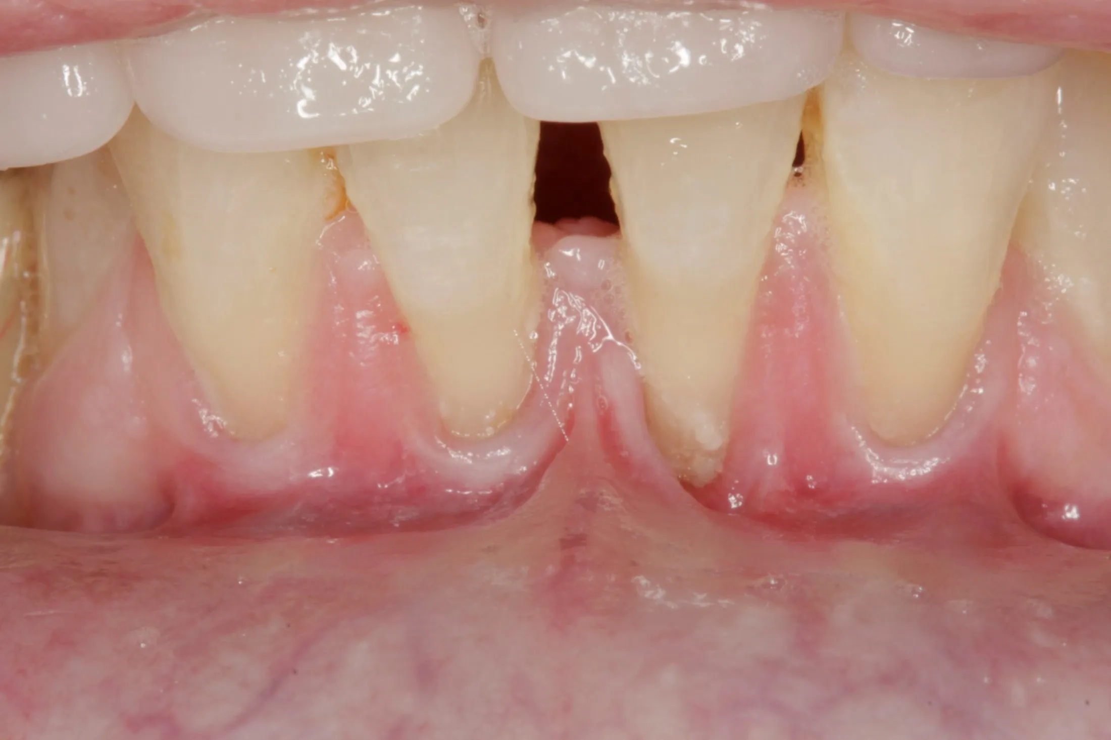 Prior to gum grafting, detailed view of gums needing treatment.
