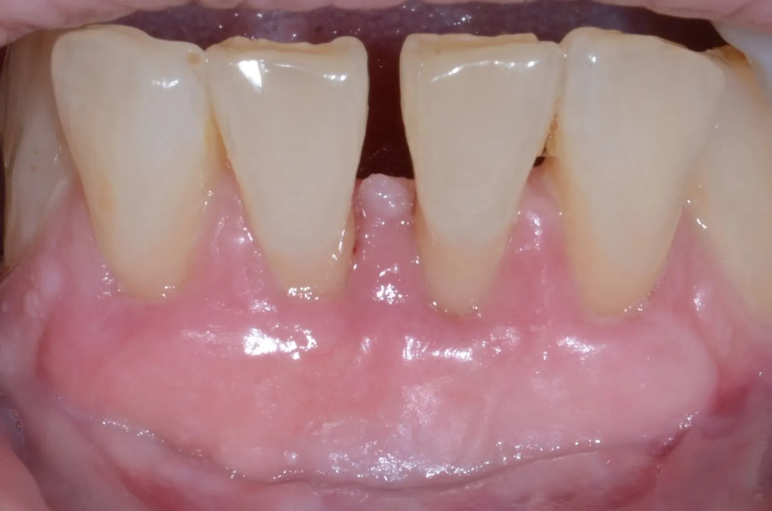 Post-procedure image showing improved gum health after grafting at Westport Periodontics.