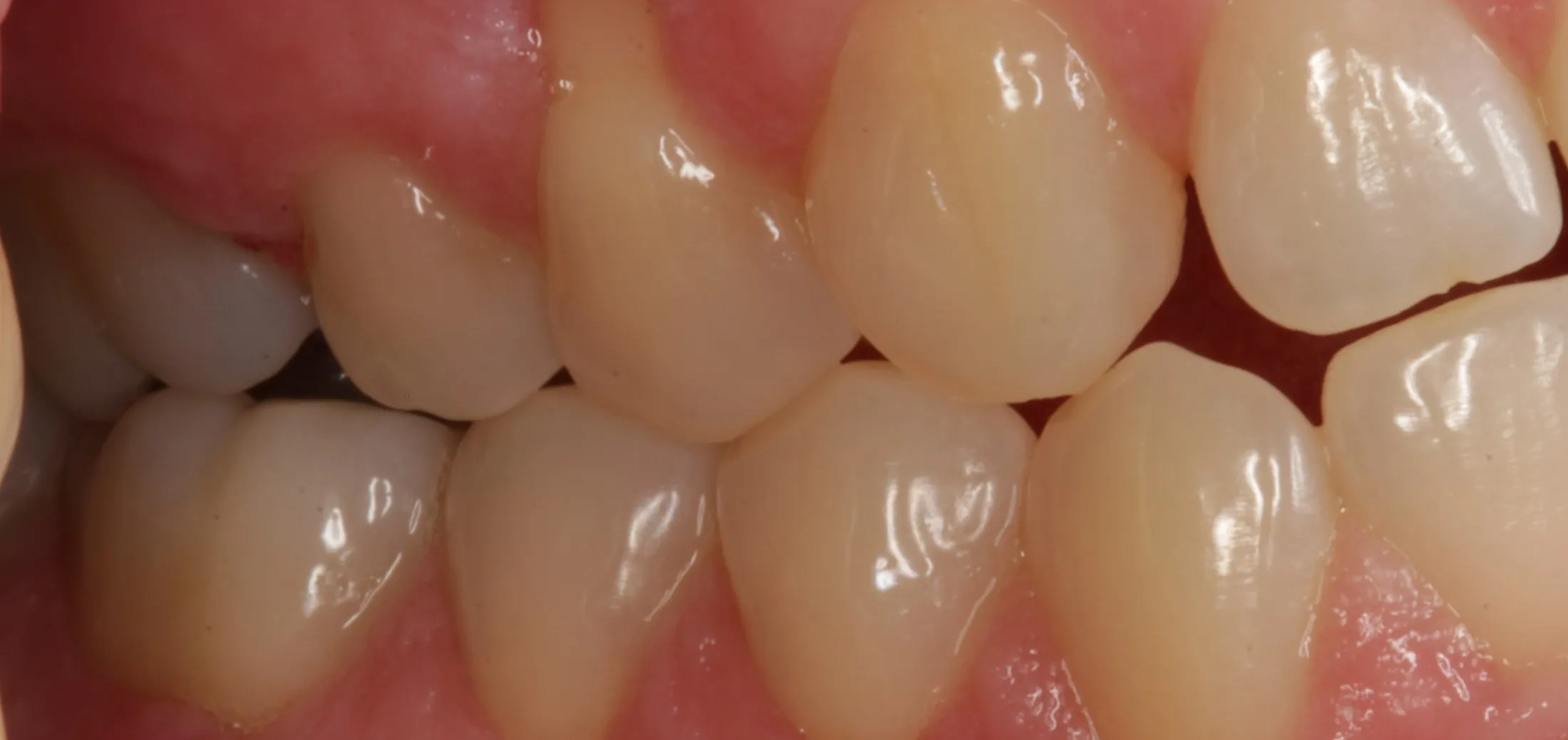 Detailed pre-treatment view of gums set for grafting surgery.