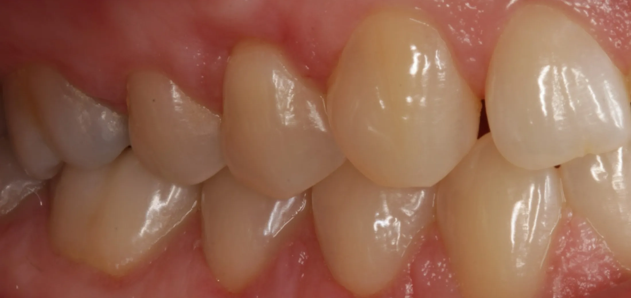 Improved gum condition visible after precise periodontal grafting.