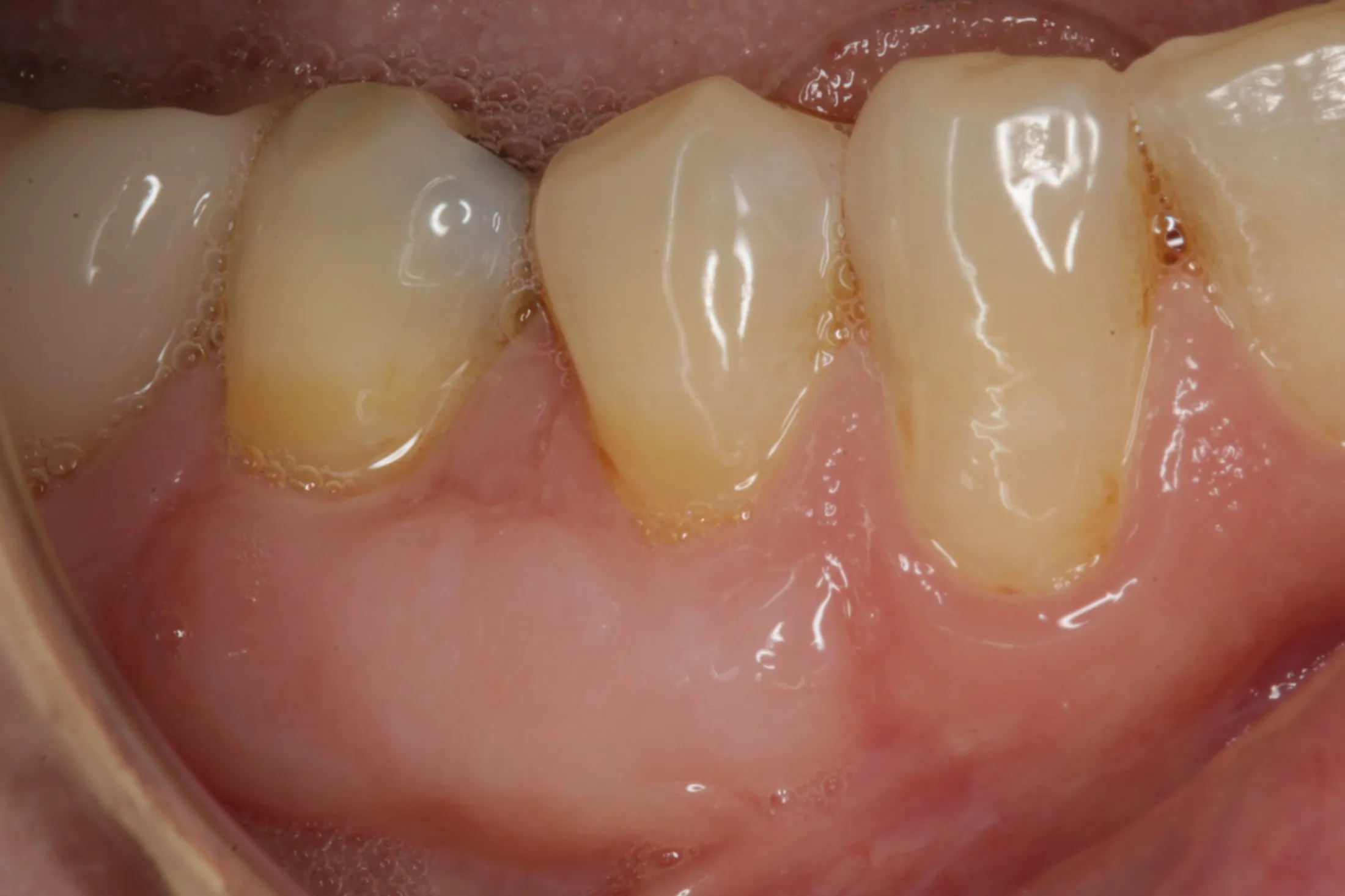 Enhanced appearance and health of gums following grafting procedure."