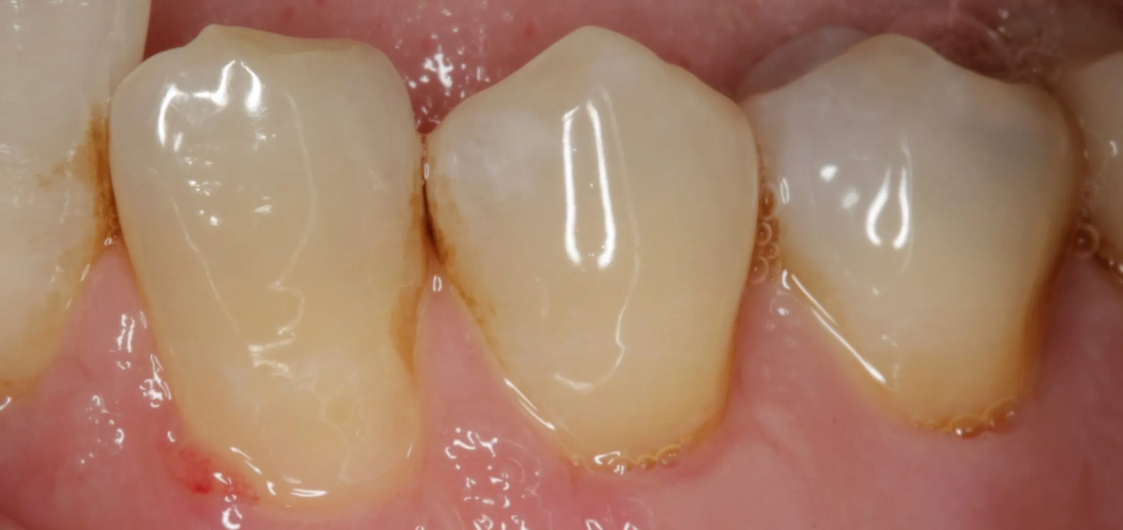 Close-up view of restored gum health following grafting treatment.