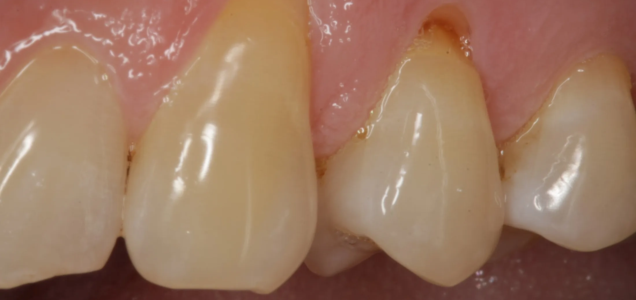 Gums before the surgical grafting intervention at Westport Periodontics.