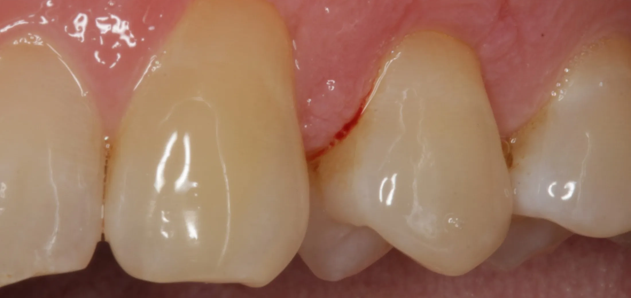 Healthy and restored gums after completion of gum grafting.