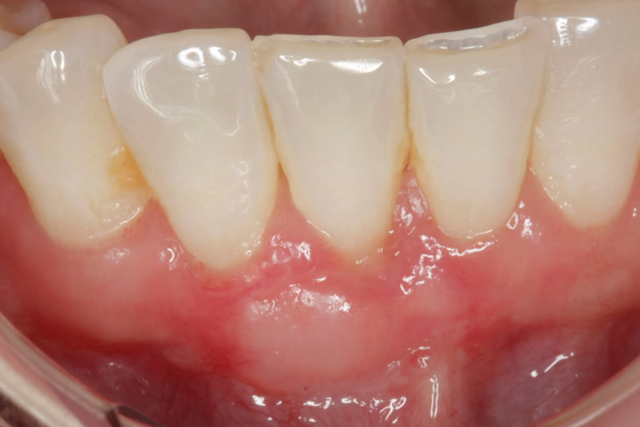 Successful restoration of gums visible after grafting treatment.
