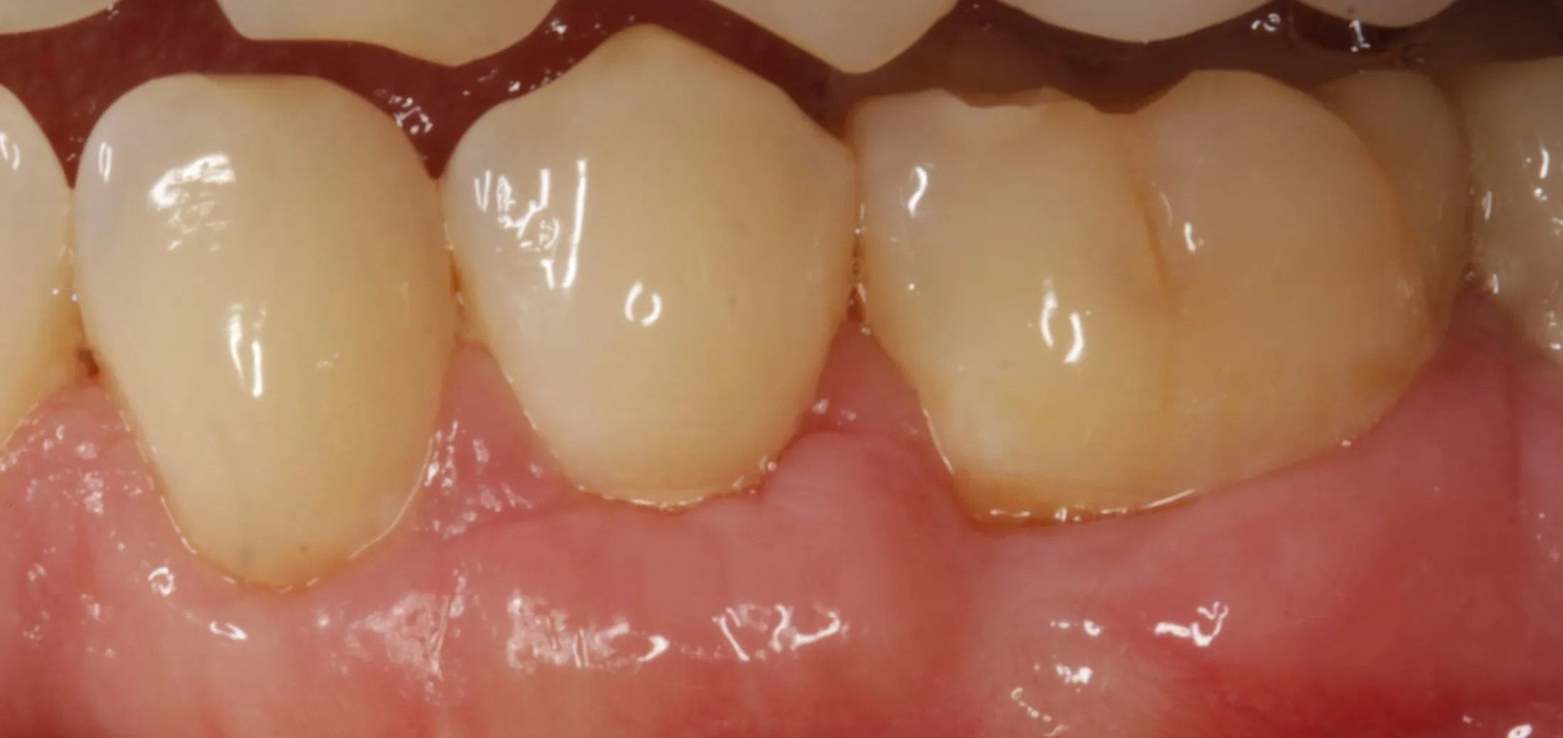 Final appearance of gums following successful periodontal grafting.