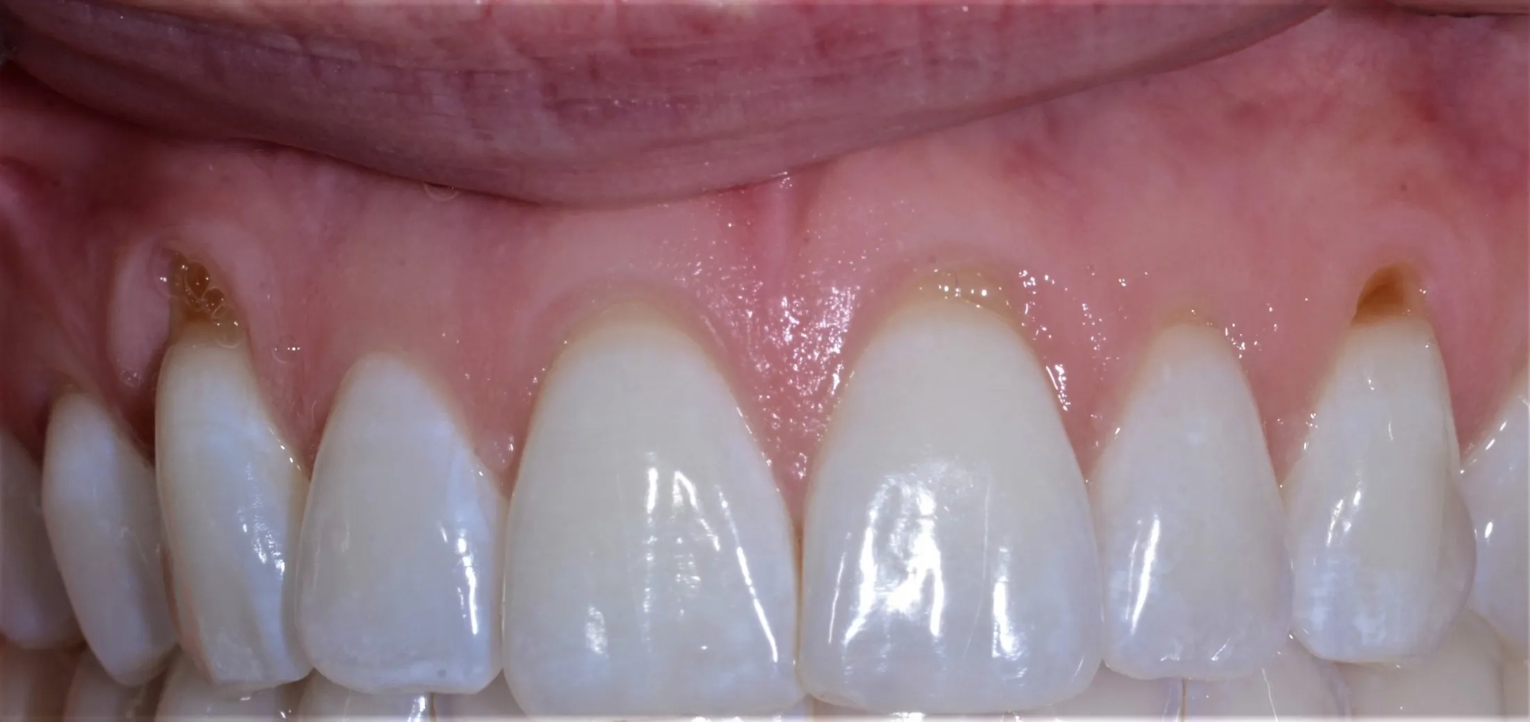Specific pre-operative condition of gums needing grafting care.