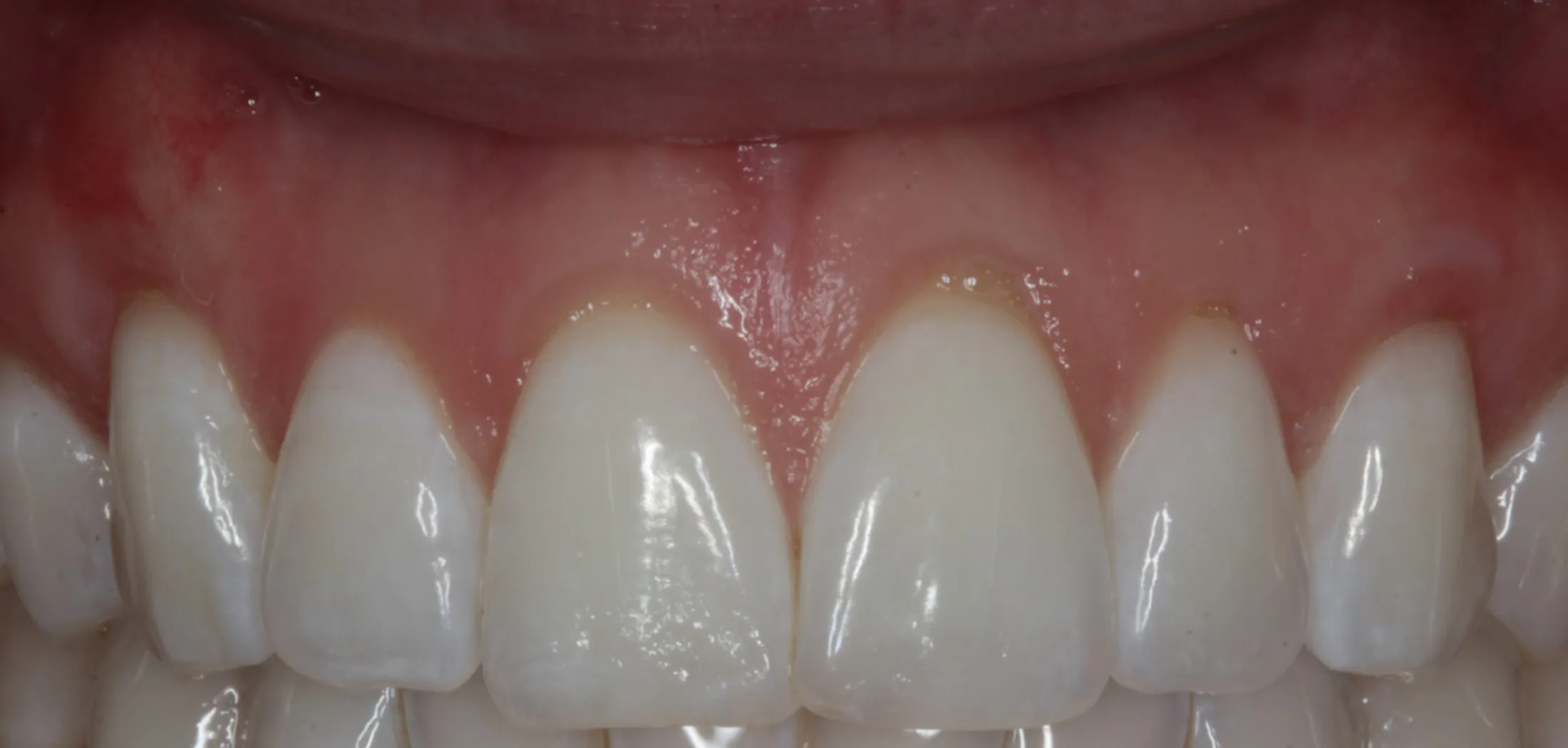 Enhanced gum health after professional treatment at Westport Periodontics.