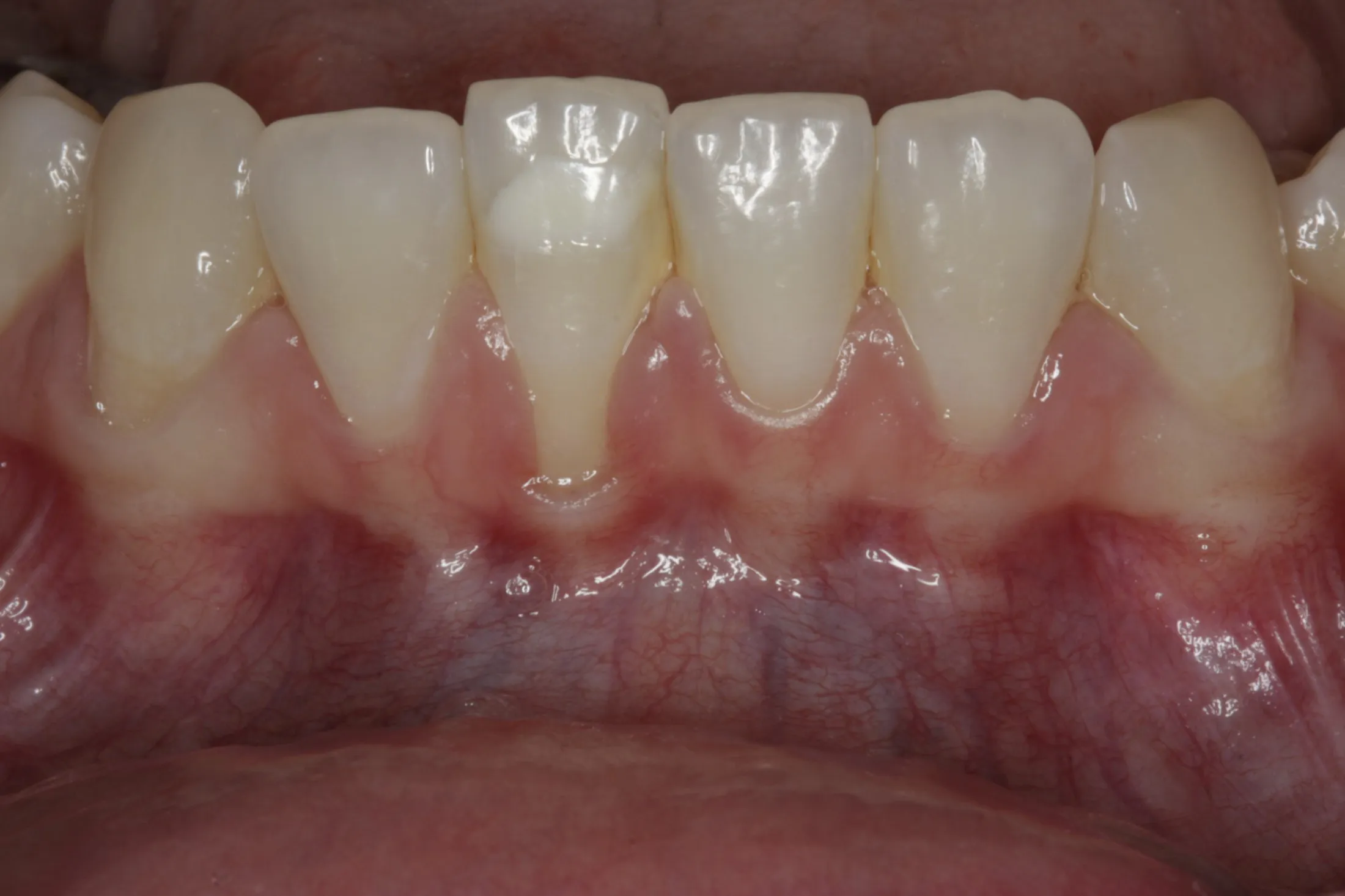 Visual before gum grafting, showing areas needing periodontal treatment at Westport Periodontics.