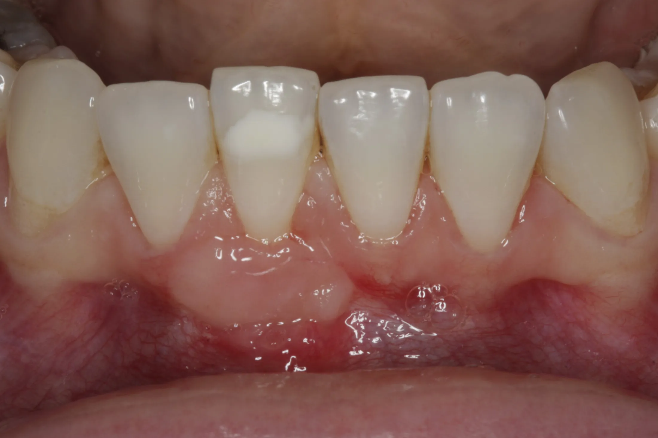 Photo of gums post-grafting, showcasing the enhanced tissue health.