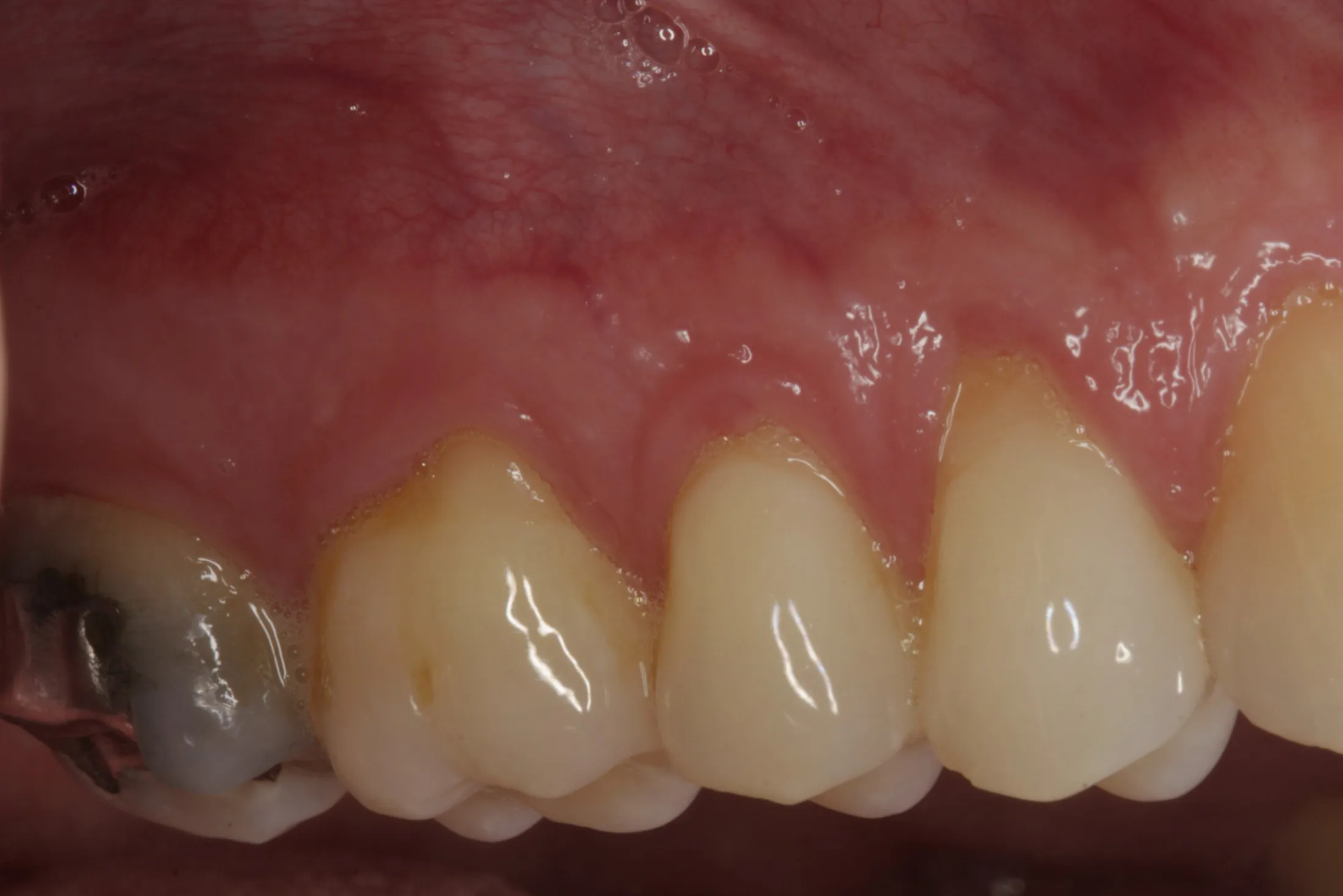 Pre-procedure image of gums prior to grafting treatment at Westport Periodontics.