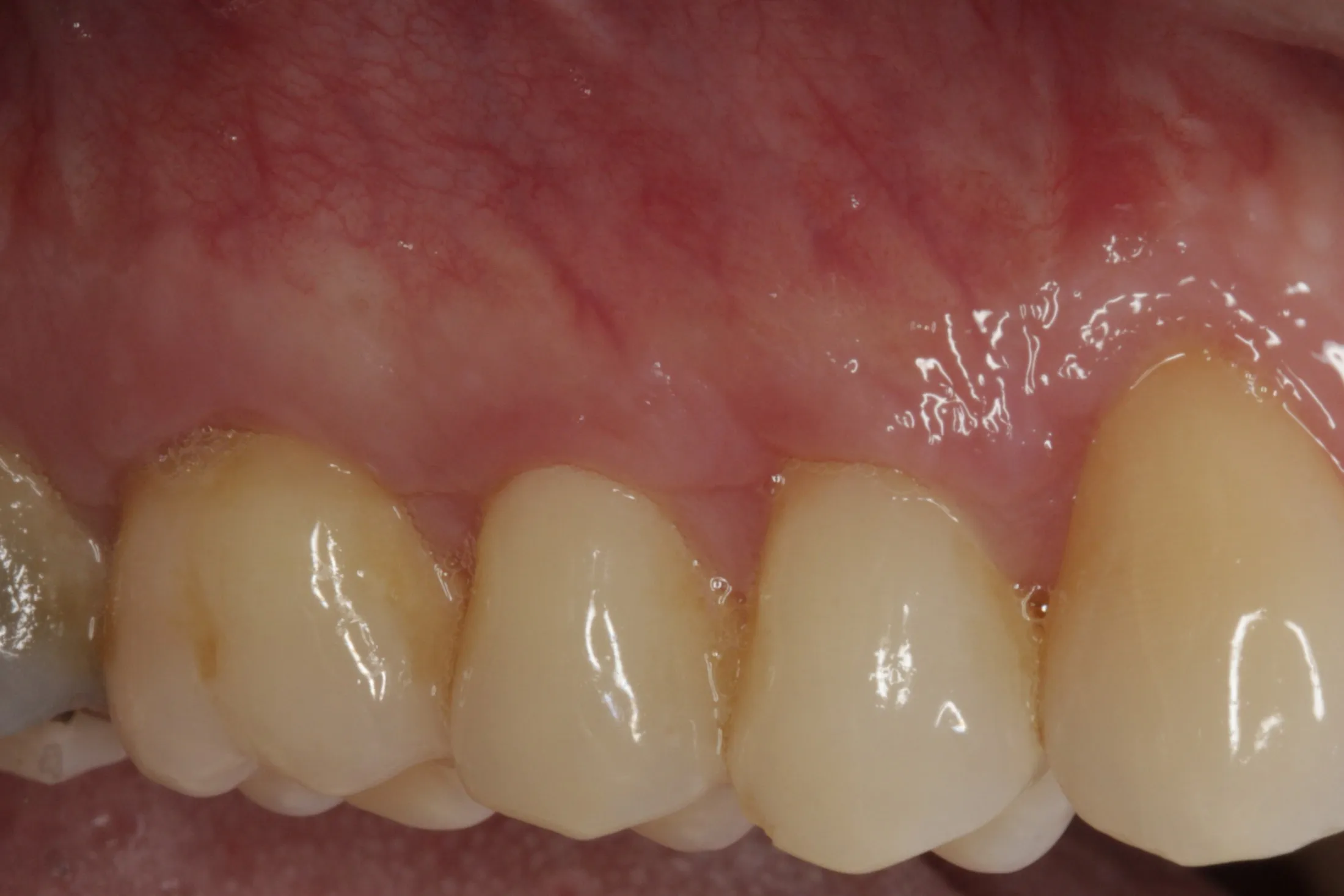 Resulting healthy gums after professional gum grafting treatment