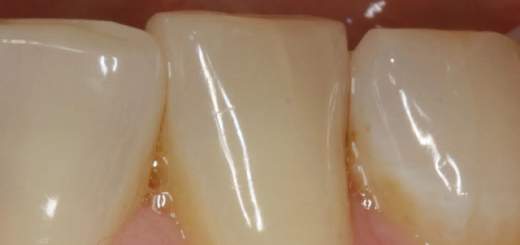 Visual of gum line prior to receiving gum grafting surgery