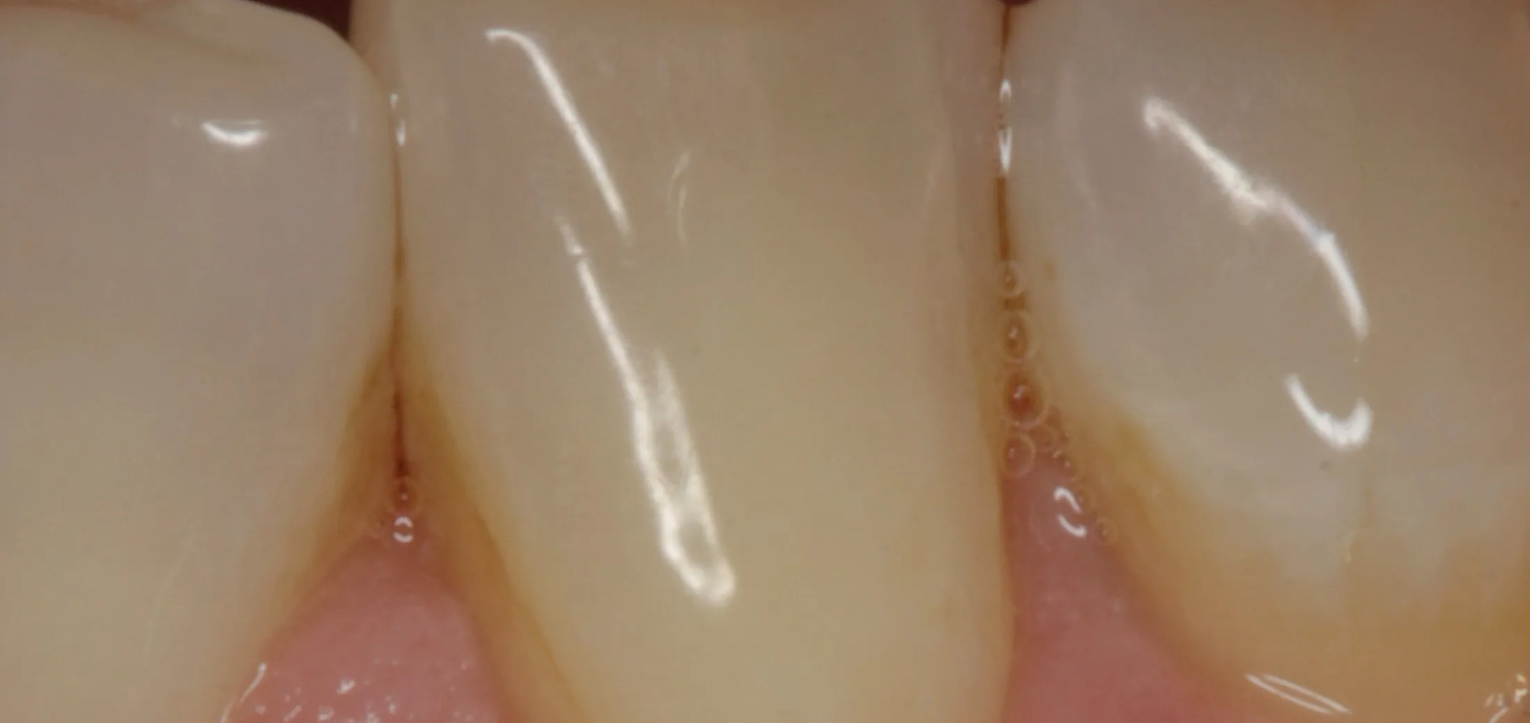 Post-operative view showcasing successful gum restoration