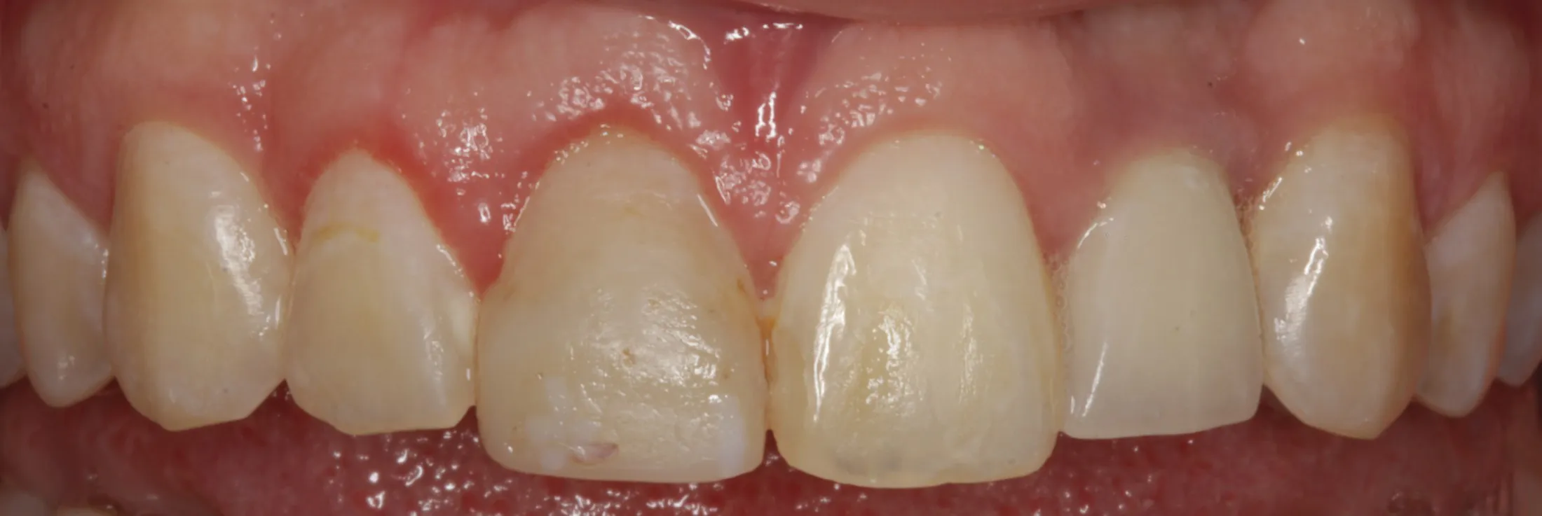 Close-up view of a healthy gum line following a successful gum grafting procedure at Westport Periodontics.