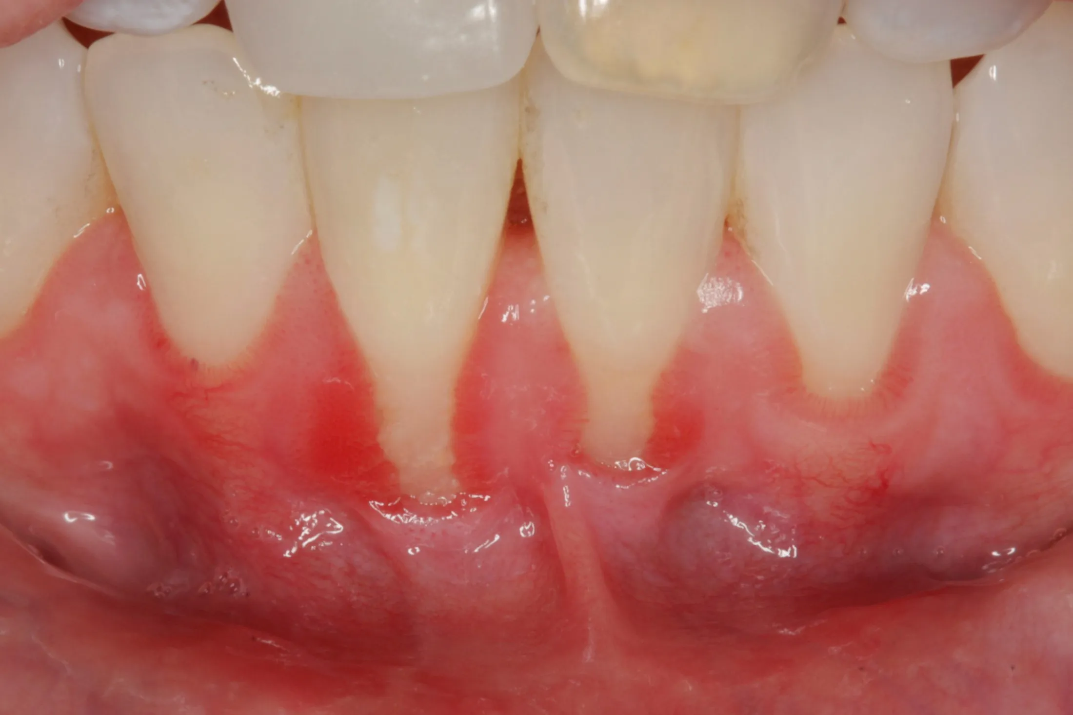 Close-up of a gum grafting procedure in progress at Westport Periodontics.