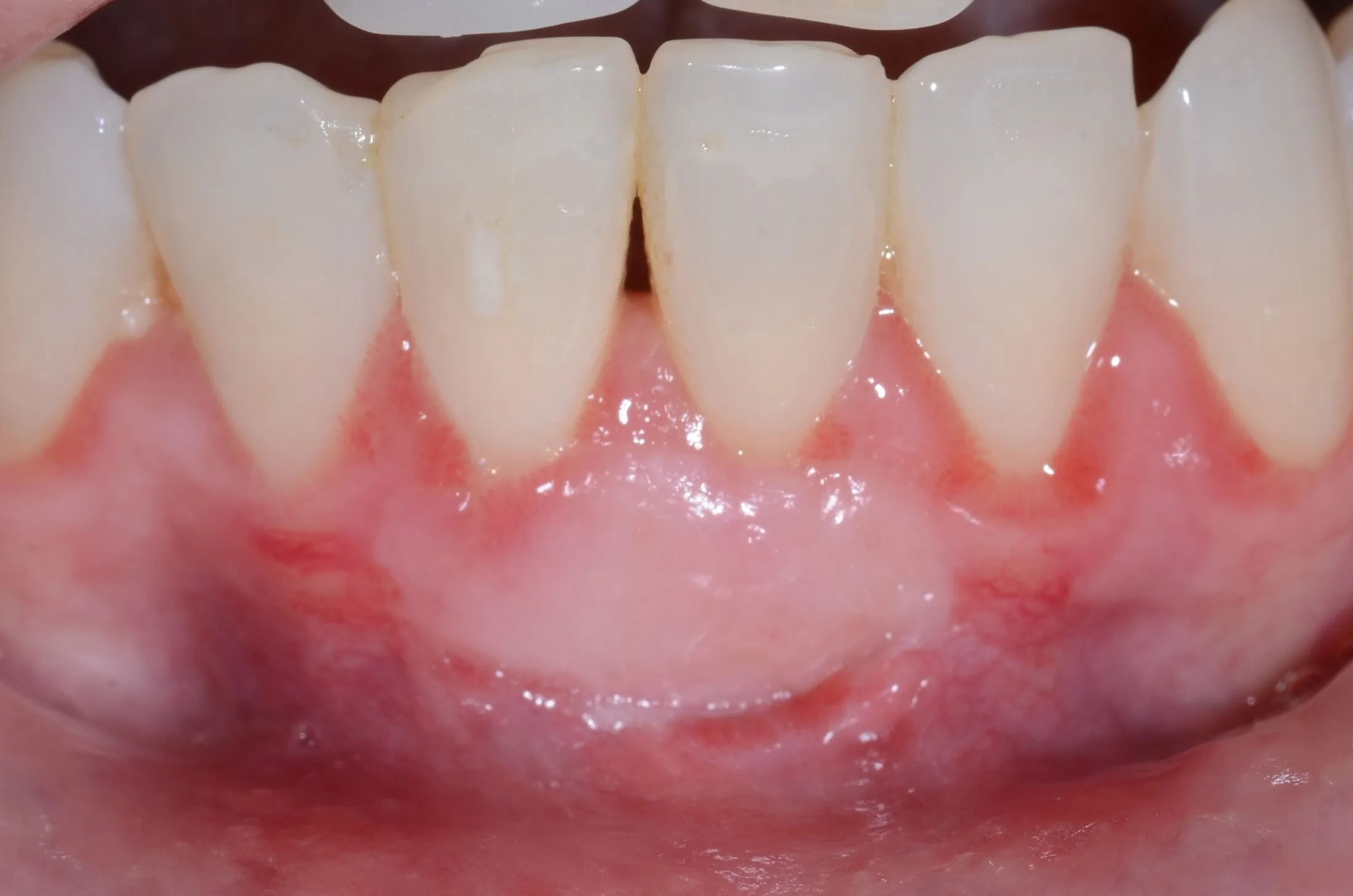 Close-up of a gum grafting procedure at Westport Periodontics.