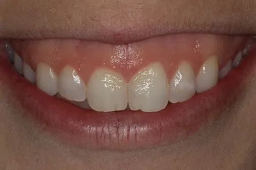 Pre-treatment photo showing initial gum line before contouring procedure at Westport Periodontics.
