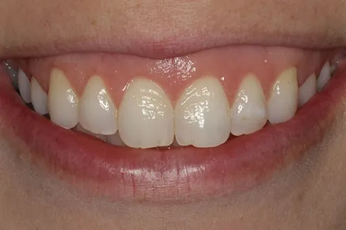 Post-treatment photo demonstrating successful gum contouring results at Westport Periodontics.